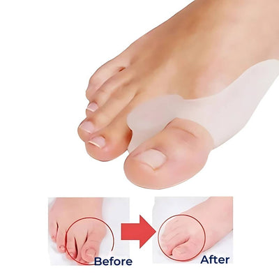 BunionGuard pour Hallux Valgus | Protection en silicone avec écarteur d’orteils – Soulagement de la douleur et alignement correctif